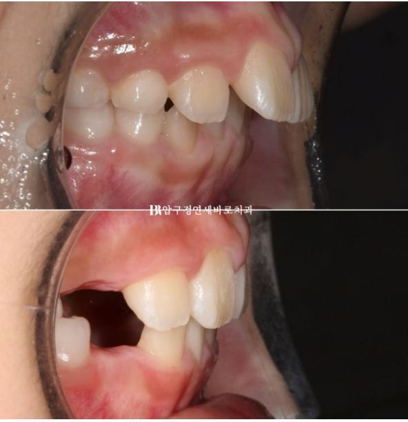 어린이 무턱 성장교정, 인비절라인 퍼스트 MA로 치료한 골격성 II급 부정교합 증례 관련 이미지 22