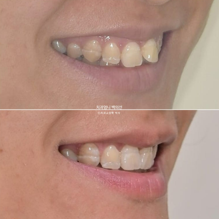 30대 교정 돌출입 교정 덧니 발치교정 치료기간 1년 8개월 관련 이미지 17