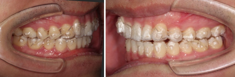 옥니 덧니 교정 왜소치 선천적 결손 3전치 무삭제 라미네이트 인비절라인 교정 관련 이미지 9