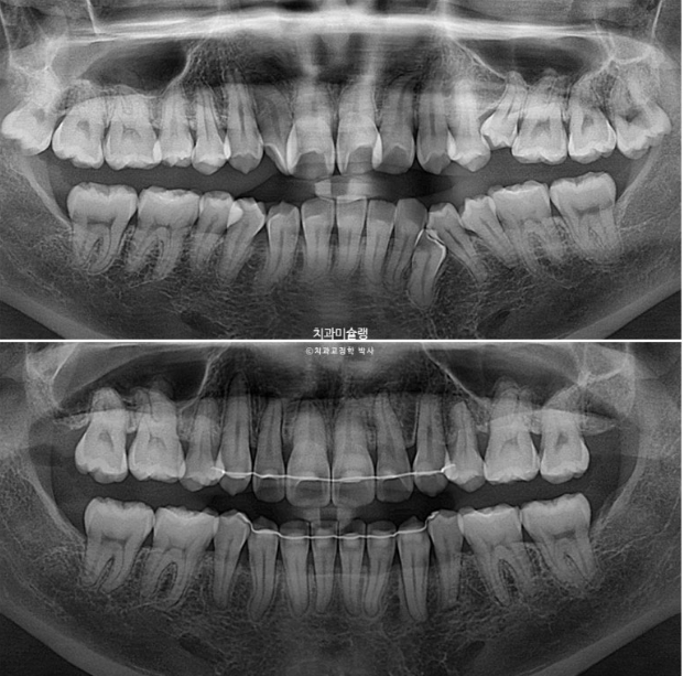 30대 인비절라인 덧니 발치교정 개방교합 치료 관련 이미지 27