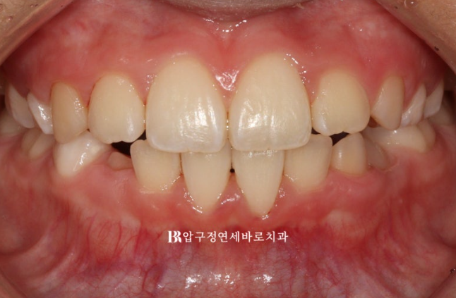 소아 투명교정 인비절라인 퍼스트 후기 기록 관련 이미지 11