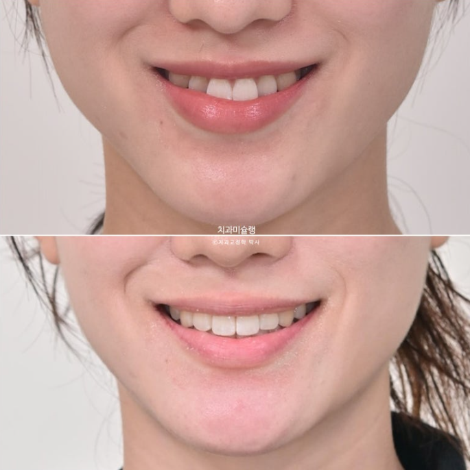 인비절라인 비발치 토끼이빨 교정 덧니 교정 치료기간 1년 8개월 관련 이미지 15
