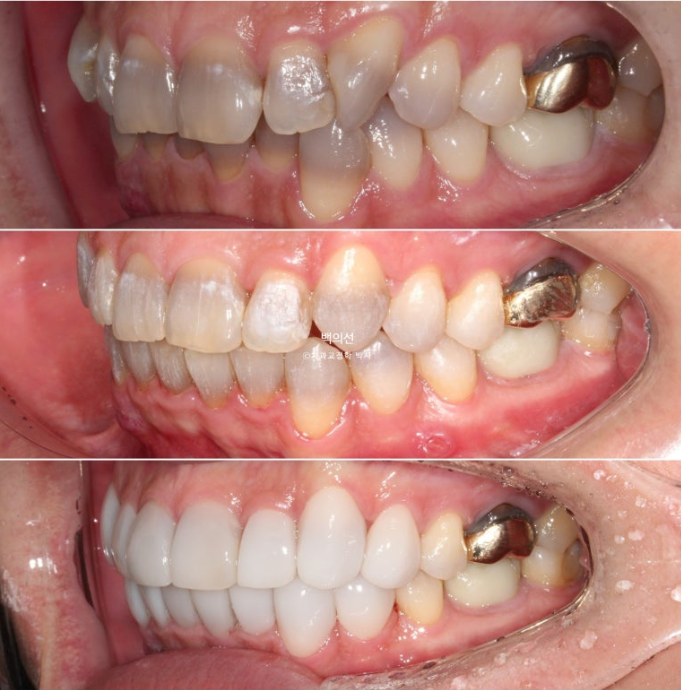 Treatment Review: No-Prep Laminate for Tetracycline-Stained Teeth image 17