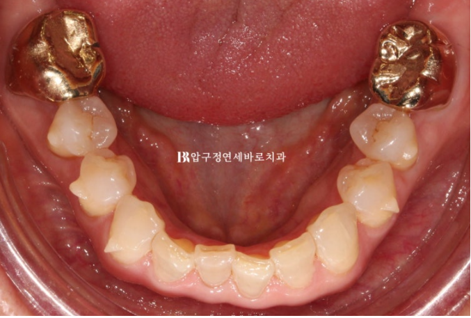 Can It Be Done in Your 50s? Real Results from Limited Front Teeth Orthodontics + No-Prep Laminate Veneers Revealed image 8