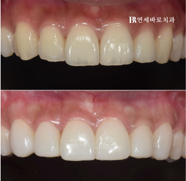 무삭제 라미네이트 젤라미 정말 최소삭제도 안할까? 관련 이미지 5