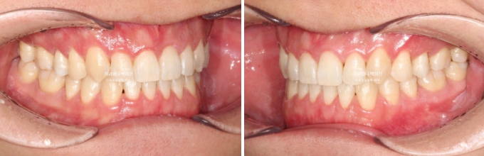 MSE Palatal Expansion Invisalign Underbite Correction, Non-Surgical image 15