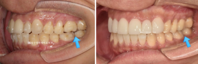 40대 중년 치아교정 인비절라인 라이트 치료기간 8개월 관련 이미지 10