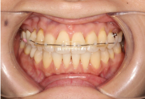 Gangnam Orthodontic Clinic: A Woman in Her 30s’ Rabbit Teeth Correction Review|Six-Month Front Teeth Partial Orthodontic Treatment That Also Improved a Crossbite image 4