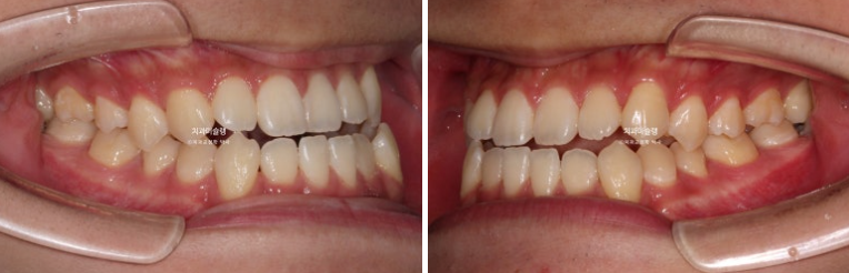 비수술 비발치 주걱턱 절충치료 클리피씨 개방교합 반대교합 치료 관련 이미지 3