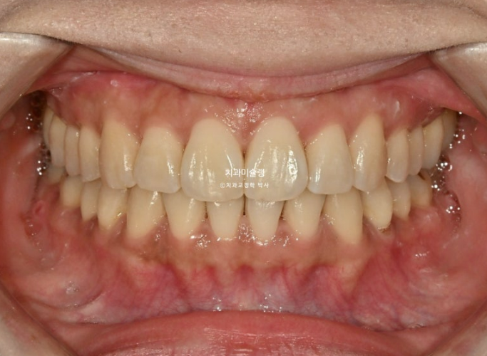 비발치 돌출입 인비절라인 교정 가위교합 중심선 맞추기 관련 이미지 18