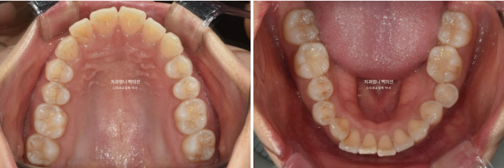 30대 돌출입 발치교정 입술부전증 치료 관련 이미지 4