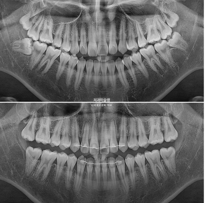 비수술 비발치 주걱턱 절충치료 클리피씨 개방교합 반대교합 치료 관련 이미지 21