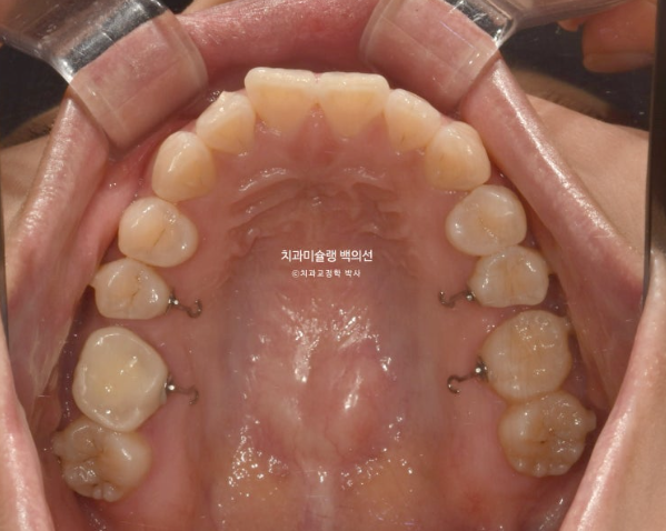 인비절라인 돌출입 발치교정 임플란트 없이 사랑니 대체 관련 이미지 11