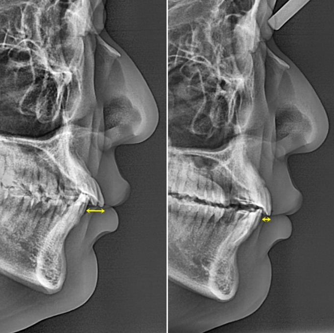 인비절라인 라이트 돌출 과개교합 중심선 교정 치간삭제 치료기간 관련 이미지 16