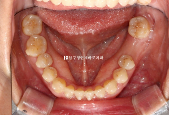 벌어진 앞니, 바로 라미네이트 하지 않은 이유｜인비절라인 후 무삭제 라미네이트 실제 사례 관련 이미지 14