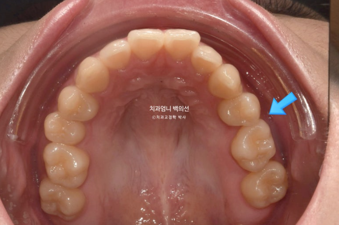 인비절라인 교정 비발치 비대칭 덧니 중심선 선천적 결손치 교정? 관련 이미지 5