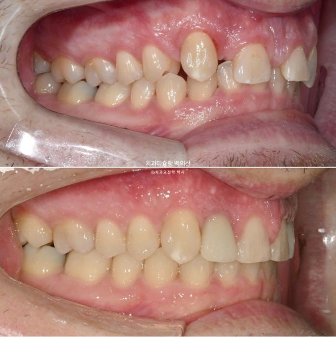 앞니 선천적 결손 인비절라인 임플란트 과개교합 치료 기간 관련 이미지 28