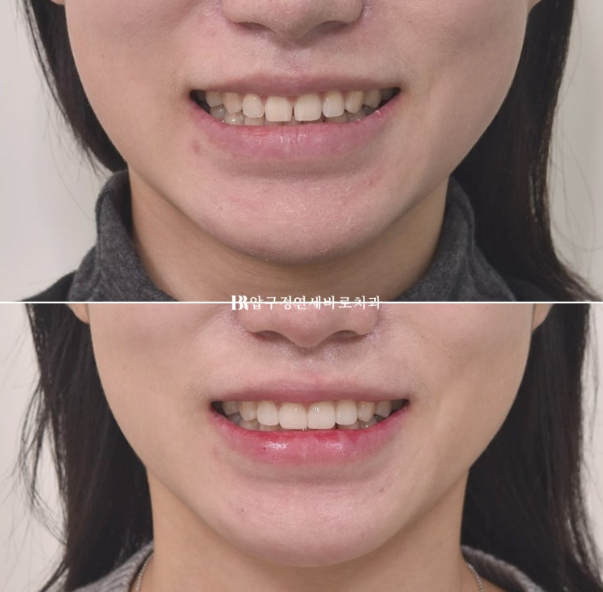 Four No-Prep Veneers for Dwarf Teeth and Conical Front Teeth image 9