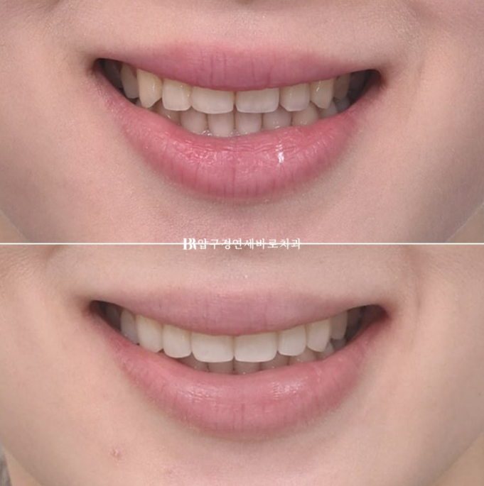 스마일라인 개선 무삭제 라미네이트 실제 두께 ? 관련 이미지 12