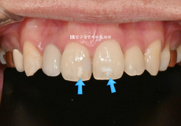 Icon White Spots on Teeth: Resin Treatment for White Spot Lesions image 5