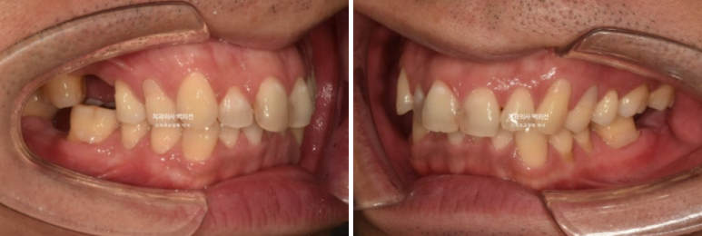 40대 인비절라인 라이트 과개교합 과잉치 덧니 교정 임플란트 보철 교정 후기 관련 이미지 4