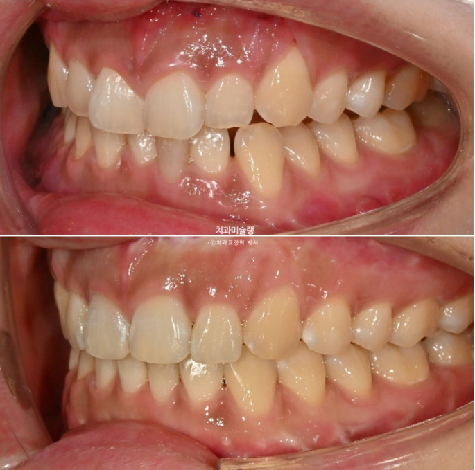 선수술 양악수술 비대칭 주걱턱 잇몸미소 치료 인비절라인 라이트 관련 이미지 19
