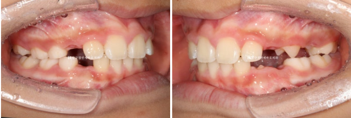 Invisalign First Correction for a Retruded Chin in a Child Orthodontic Treatment for Protrusion image 17