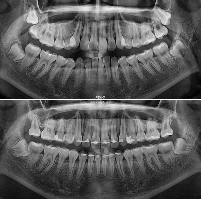 비발치 덧니교정 인비절라인 교정 사랑니 이용 교정 관련 이미지 22