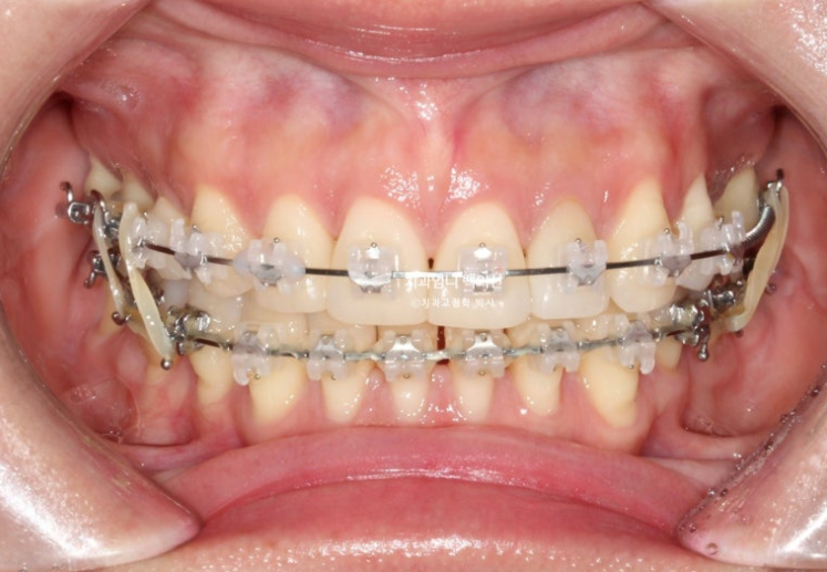 옥니 교정 역교정 재교정 무턱교정 치료기간 1년 10개월 관련 이미지 12