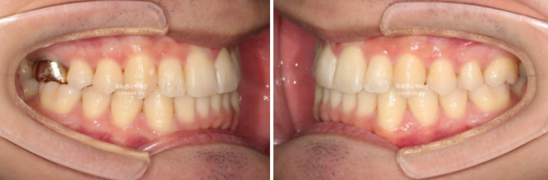 인비절라인 비발치 앞니 돌출 교정 치료기간 2년 5개월 관련 이미지 11