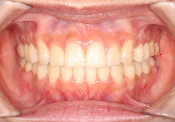 인비절라인 돌출입 발치교정 임플란트 없이 사랑니 대체 관련 이미지 18