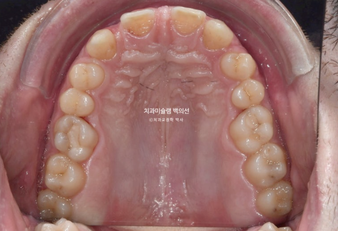 앞니 선천적 결손 인비절라인 임플란트 과개교합 치료 기간 관련 이미지 5