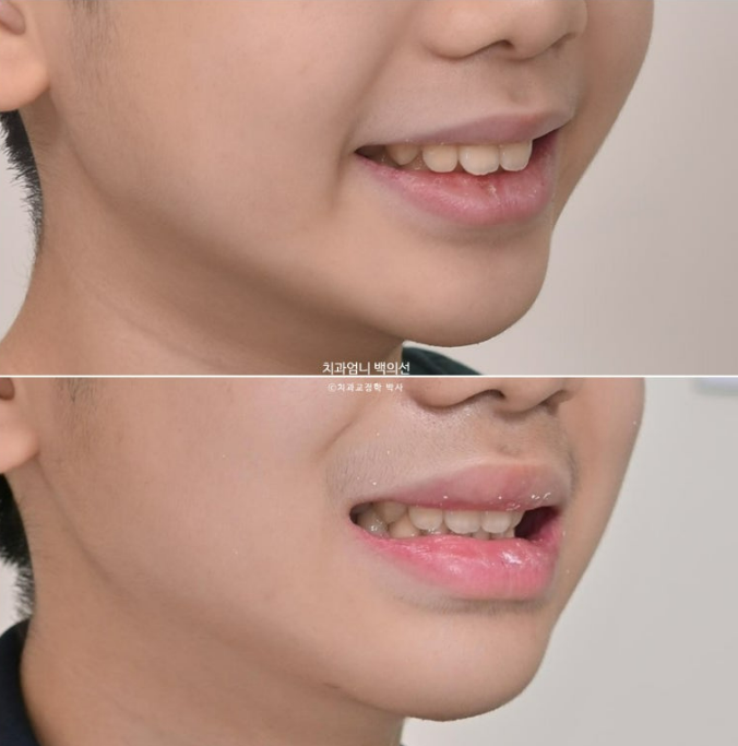 어린이 투명교정 인비절라인 퍼스트 가위교합 돌출교정 덧니교정 관련 이미지 15