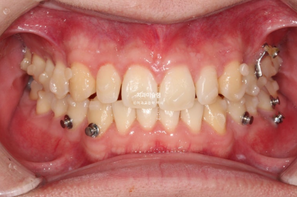 비대칭 비발치 거미스마일 잇몸미소 중심선 가위교합치료 무삭제 라미네이트 관련 이미지 14