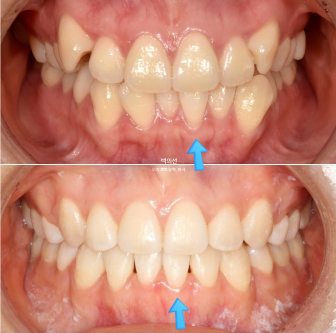 덧니 발치교정 클리피씨 입매 부작용 인중 입술 잇몸 퇴축 관련 이미지 13