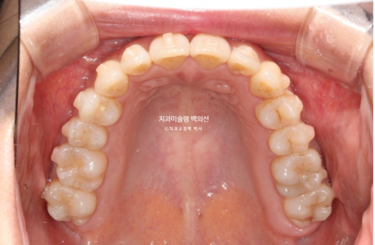옥니 덧니 과개교합 반대교합 중심선 인비절라인 치료기간 1년 관련 이미지 9