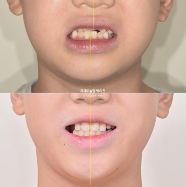 어린이 비대칭 반대교합 주걱턱 인비절라인 퍼스트 프리올소 성장 교정 관련 이미지 1