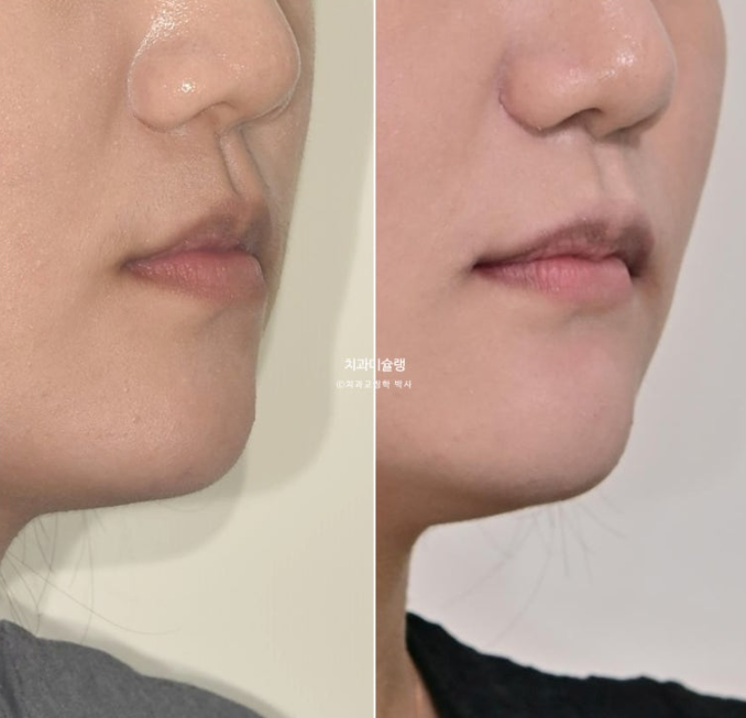 비발치 비수술 주걱턱 반대교합 재교정 치료 관련 이미지 18