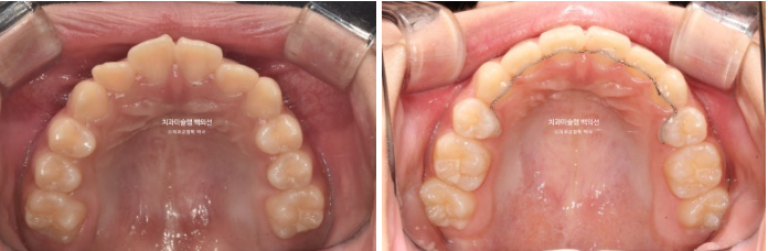 돌출입 무턱 인비절라인 발치교정 덧니 치료기간 1년 11개월 관련 이미지 12