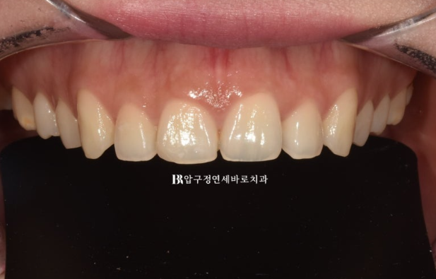 Before and After Non-Prep Veneers: Improving Gaps Between the Front Teeth and the Smile Line Together image 3