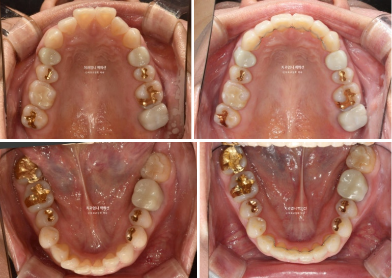 50대 치아교정 교합평면 기울어짐 토끼이 덧니 교정? 관련 이미지 11