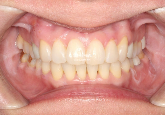 50대 치아교정 교합평면 기울어짐 토끼이 덧니 교정? 관련 이미지 8