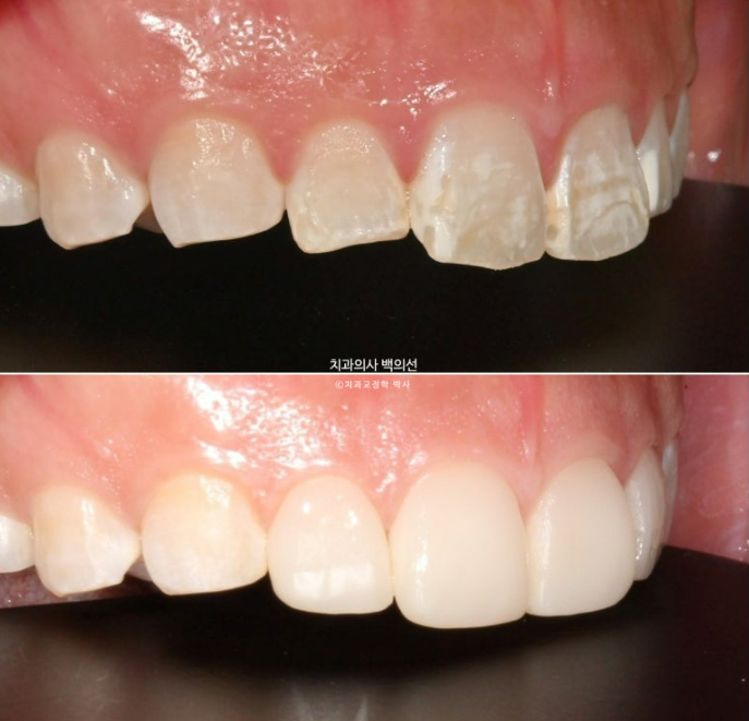 반점치 반상치 치아 하얀 얼룩 치료하기 관련 이미지 1