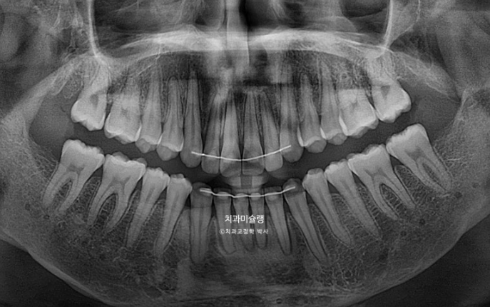 선수술 양악수술 비대칭 주걱턱 잇몸미소 치료 인비절라인 라이트 관련 이미지 20