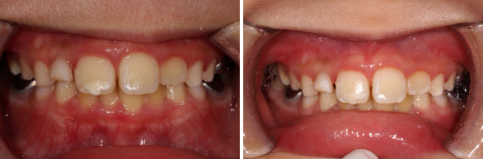 A Real Case of Preventing Crowded Teeth with Invisalign First for a Child in Gangnam image 1