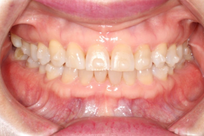 50대 치아교정 :: 인비절라인 익스프레스 치아 벌어짐 단기교정 후기 관련 이미지 9