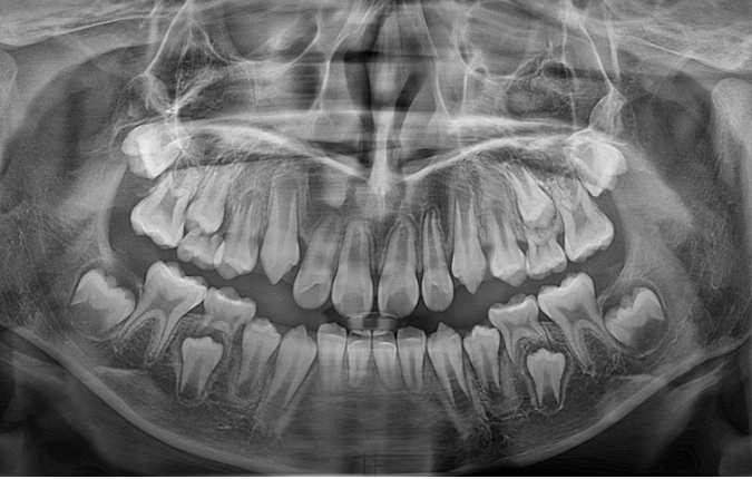 Pediatric Clear Aligners That Improved Both Deep Bite and Protruding Teeth image 4