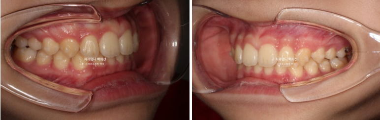 어린이 투명교정 인비절라인 퍼스트 가위교합 돌출교정 덧니교정 관련 이미지 6