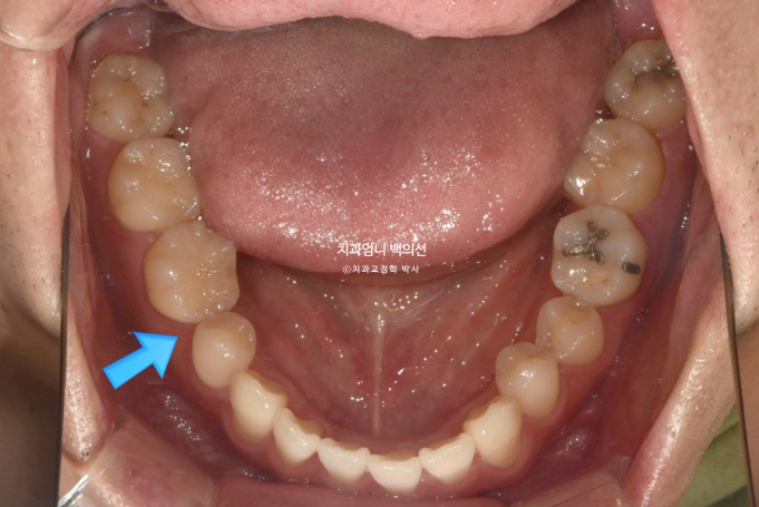 주걱턱 교정 반대교합 소구치 선천적 결손 부정교합 비발치 교정 후기 관련 이미지 6