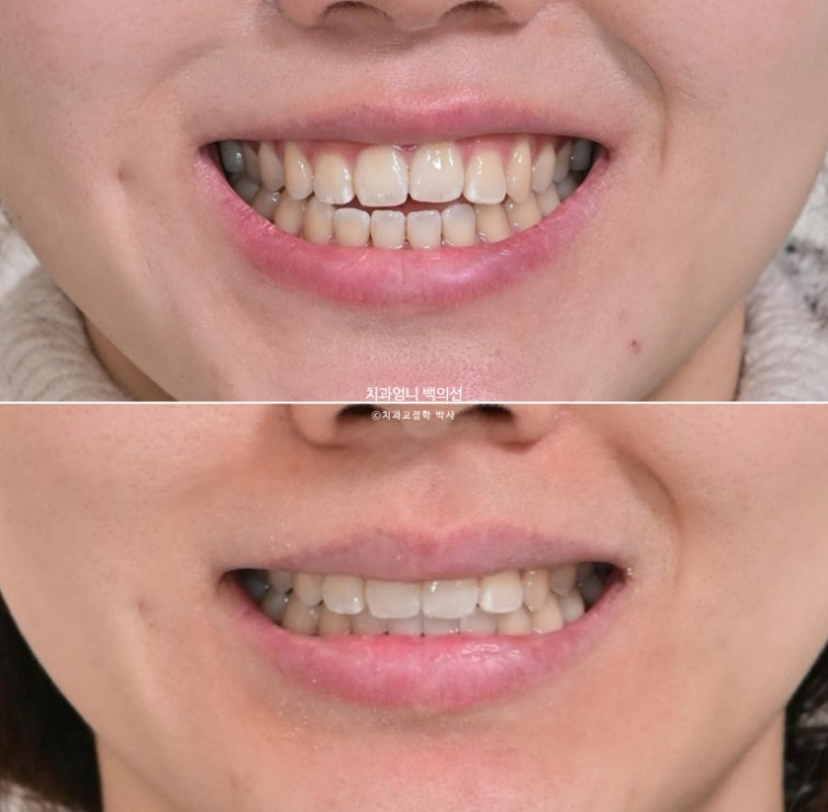 앞니 단기 부분교정 재교정 개방교합 교정 후기 관련 이미지 15
